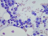 myeloma cell